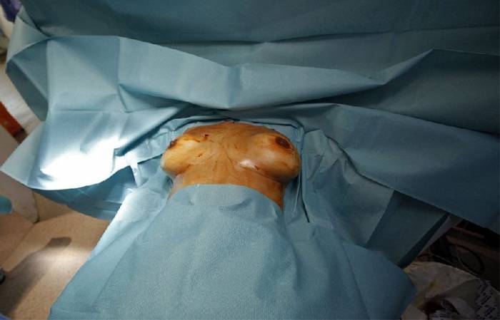 Замена грудных силиконовых имплантов (12 фото)