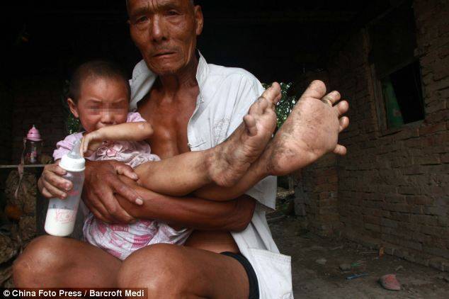 У трехлетней девочки огромные ступни ног (5 фото)