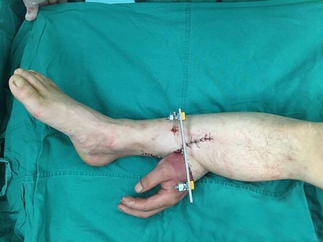 Врачи пришили оторванную кисть пациента к его лодыжке (4 фото)