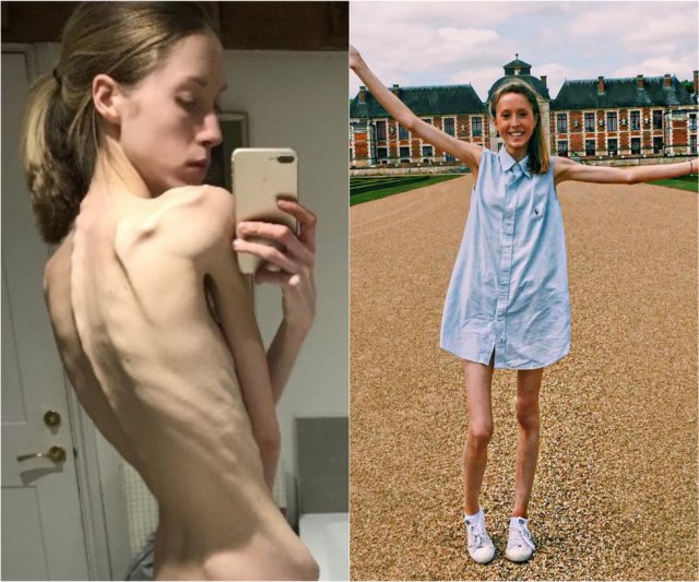 Девушка следила за своим питанием и довела себя до анорексии (5 фото)